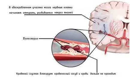 Stem prognoza accident vascular cerebral pentru recuperare, ceea ce este, dacă recuperarea este posibilă