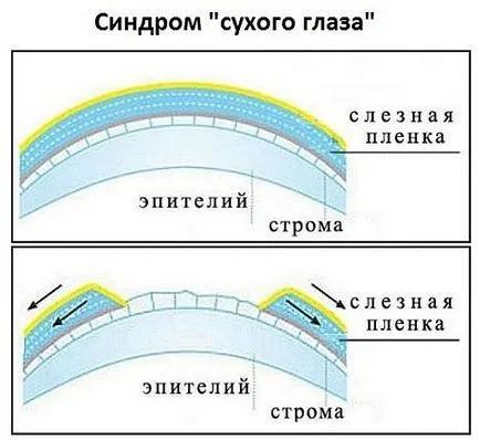 „ochi uscat“ simptome sindrom si tratament, remedii populare cu sindrom de ochi uscat (sindrom) „ochi uscat“ simptome sindrom si tratament, remedii populare în sindromul de ochi uscat