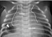 Thymomegalia - cauze, simptome, diagnostic și tratament