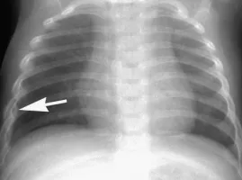 margini fisurei - cauze și simptome ale unei coaste fisurate (tratament) fractura Rib - cauze și simptome ale unei coaste crăpate