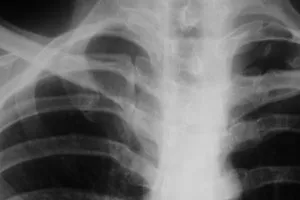 Fisurarea margini - cauze și simptome ale nervurii (e) cracate pentru fractura Rib - cauze și simptome ale unei coaste crăpate