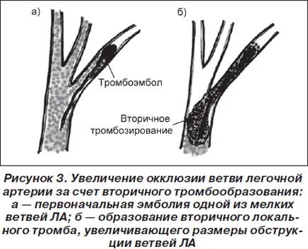 Pulmonare diagnostic si tratament embolism algoritmi, portal de radiologi