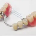Îndepărtarea tartrului, costul lucrărilor și comentarii, prețul pentru îndepărtarea și curățarea (dentare) Îndepărtarea tartrului, costul lucrărilor și comentarii, prețul pentru îndepărtarea și curățarea