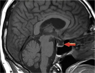descriere creier Ephippium, funcții
