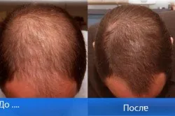Ultra indicatii fixativ pentru utilizare și feedback-ul clienților despre droguri