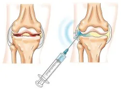 Injecțiile la articulațiile pacienților cu privire la ceea ce este important să se cunoască pacientul (injecții) Injecțiile la articulațiile pacienților cu privire la ceea ce este important să se cunoască pacientul