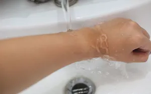 simptome muscatura Ant, tratament, remedii populare, ceea ce este utilizarea (semne) simptome muscatura Ant, tratament, remedii populare, ceea ce este utilizarea