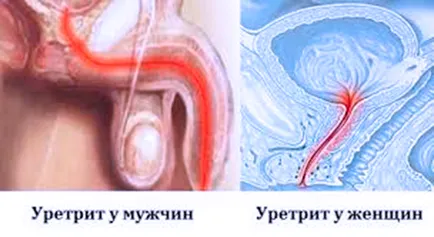 Simptomele uretrită și tratamentul remedii populare (populare) Simptomele uretrită și tratamentul de remedii populare