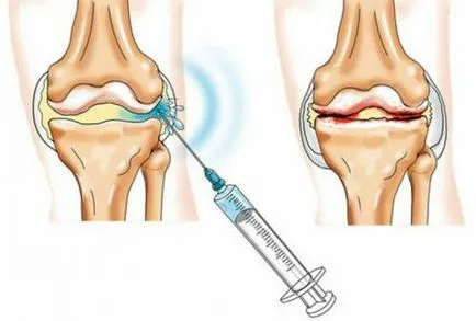 Injecțiile de revizuire comună a injecțiilor și blocade în tratamentul artrozei și artritei