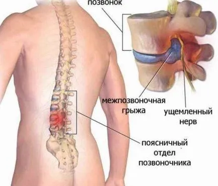 Exerciții la hernia lombare 6 tipuri de exerciții