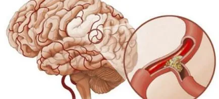 simptome vasospasm cerebrovasculare si tratament
