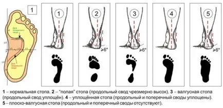 Valgus picior deformare în patologia copii fotografie (picioare) Valgus picior deformare în patologia copii fotografie