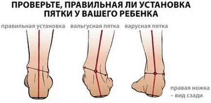Valgus picior deformare la copii fotografie, tratament, cauze, simptome (copii) Valgus picior deformare la copii fotografie, tratament, cauze, simptome