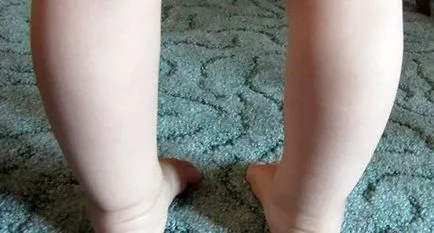Valgus picior deformare în patologia copii fotografie (picioare) Valgus picior deformare în patologia copii fotografie