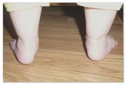Valgus picior deformare la copii fotografie, tratament, cauze, simptome (valgus deformare picior la copii) Valgus picior deformare la copii fotografie, tratament, cauze, simptome