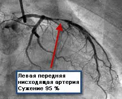 Tipuri de tratament chirurgical al infarctului miocardic