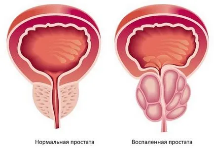 Tipuri și simptome de prostatita