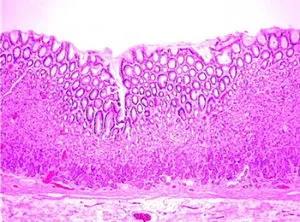 hyperemic mucoasei gastrice