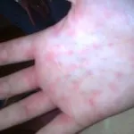 Virusul Epstein-Barr la copii simptome, diagnostic și tratament al avizului Komarovka