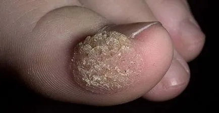 papilomatoza virus