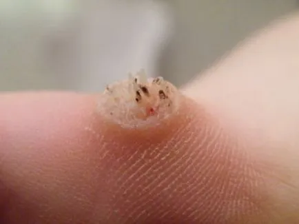 papilomatoza virus