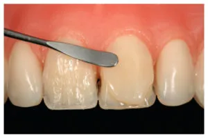 Restaurarea dinte frontal rupt