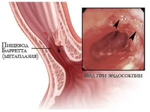 Inflamarea simptomele esofagului si remedii populare de tratament