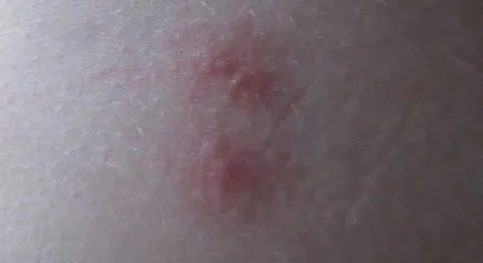 blistere lăcrimarea pe fotografie corp, este posibil boală, tratament, boli de piele