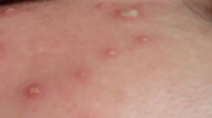 blistere lăcrimarea pe fotografie corp, este posibil boală, tratament, boli de piele