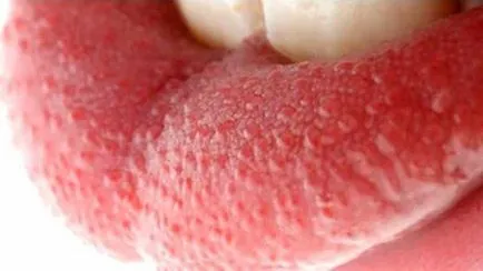 papile inflamata pe fotografie limba, extinsă la rădăcina (limba) papile inflamata pe fotografie limba, extinsă de la rădăcină
