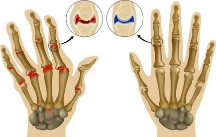 Inflamația degetul pe de altă patologie de bază și tratament (inflamația) Inflamația degetul pe principalele patologii de mana si tratamentul acestora