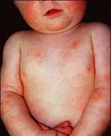 Toate dermatitei la copii și tratamentul acestora (copii cu dermatită atopică) Toate dermatitei la copii și tratarea acestora