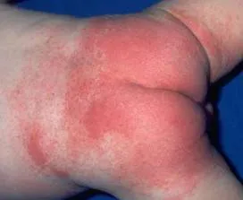 Toate dermatitei la copii și tratamentul acestora (copii cu dermatită atopică) Toate dermatitei la copii și tratarea acestora