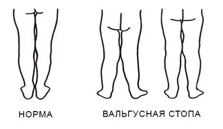 Totul despre deformare valgus a picioarelor la copii - masaje, tratamente (de dezvoltare a sistemului musculo-scheletice) Totul despre deformare valgus a picioarelor la copii - masaj, tratament