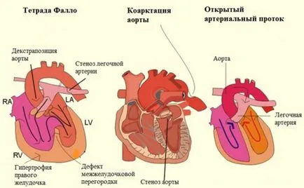 boli cardiace congenitale - cauze, simptome si tratament (anomalii mici de dezvoltare a inimii) Bolile cardiace congenitale - cauze, simptome și tratament