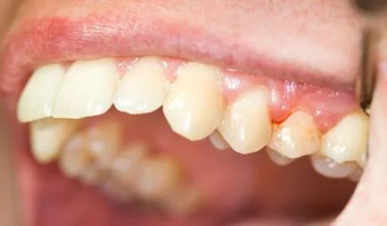 granularea periodontita cronica cauze de tratament, diagnosticarea bolii (tratament) Tratamentul cronic granularea periodontita, cauzele, diagnosticarea bolii