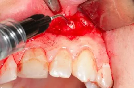 granularea periodontita cronica cauze de tratament, diagnosticarea bolii (parodontită cronică) granularea Tratamentul cronic granularea periodontita, cauzele, diagnosticarea bolii