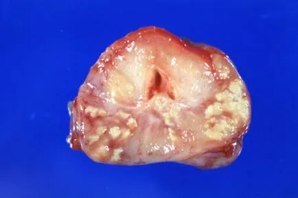 Boli ale glandei prostatei la bărbați de prostată diferite diagnostice și cauze comune