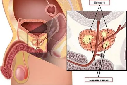 Boli ale glandei prostatei la bărbați de prostată diferite diagnostice și cauze comune