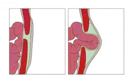 Parcela unei hernii la adulți și copii (adulți conspirație hernii) Parcela unei hernii la adulți și copii