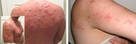 Alergiile la mușcăturile de insecte de purici, țânțari și ploșnițe, tratamentul adulților și copiilor, mușcături foto