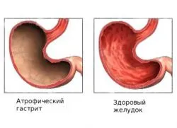 Atrofia mucoasei gastrice