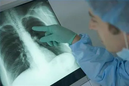 Bronhodilatatori lista de medicamente bronșită, instrucțiuni