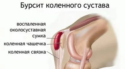 Bursită a genunchiului - cauze, simptome, tratament (motive) Bursită a genunchiului - cauze, simptome, tratament