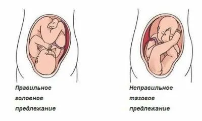 Displazia de sold la simptome de copii, diagnostic și tratament