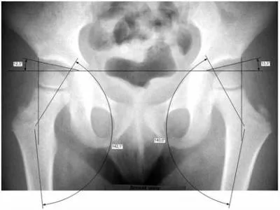 Displazia de sold la simptome de copii, diagnostic și tratament