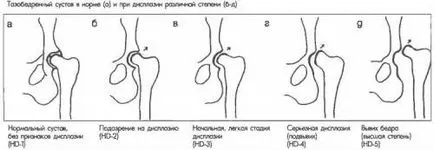 Displazia de sold la simptome de copii, diagnostic și tratament