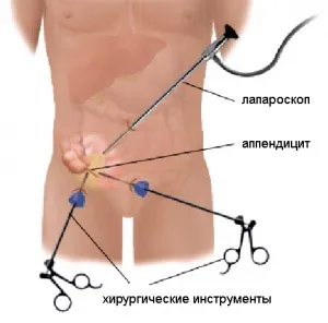 Flegmonoasă apendicita tratament, dieta dupa operatie, complicații și consecințe