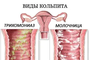Lista bolilor ginecologice din cele mai comune (boala) Lista bolilor ginecologice dintre cele mai frecvente