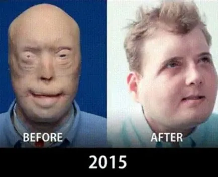fotografii comparative care arată modul în care transplanturi de fata au venit in 10 ani, umkra